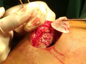 minced cartilage 3